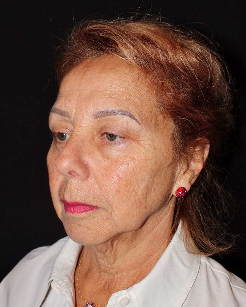 Facelift Before & After Gallery - Patient 304571 - Image 3