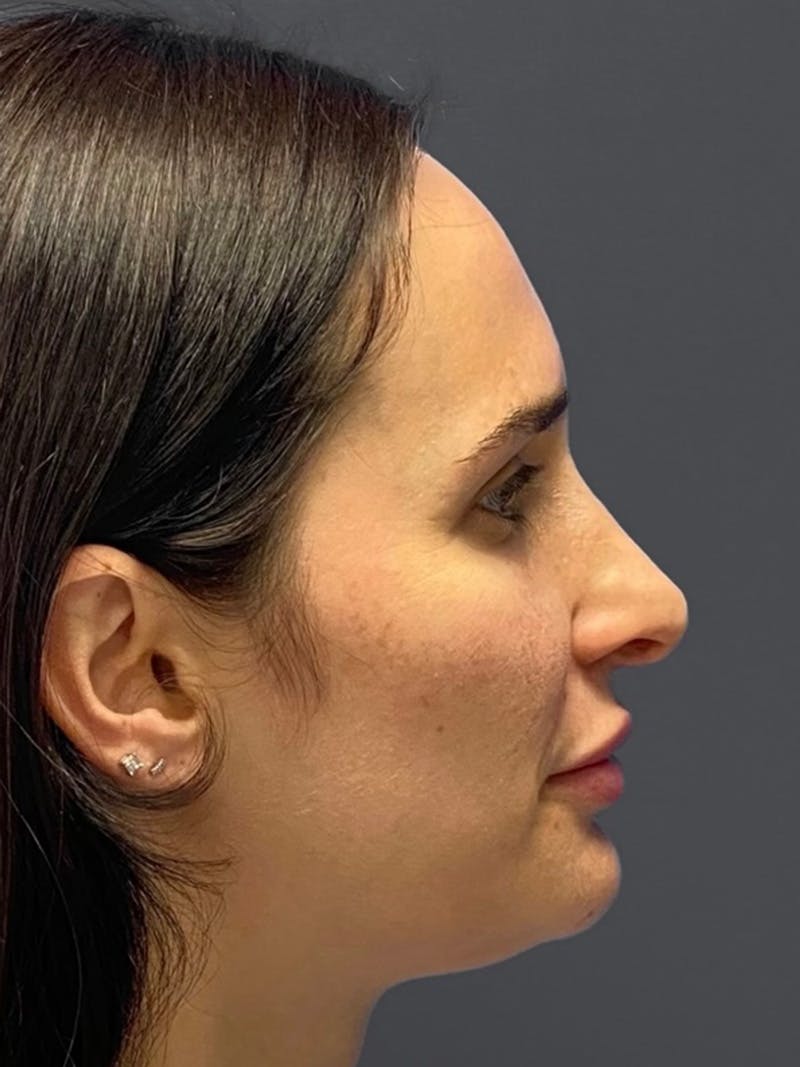Revision Rhinoplasty Before & After Gallery - Patient 240059 - Image 1