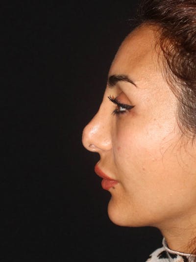 Revision Rhinoplasty Before & After Gallery - Patient 319821 - Image 1