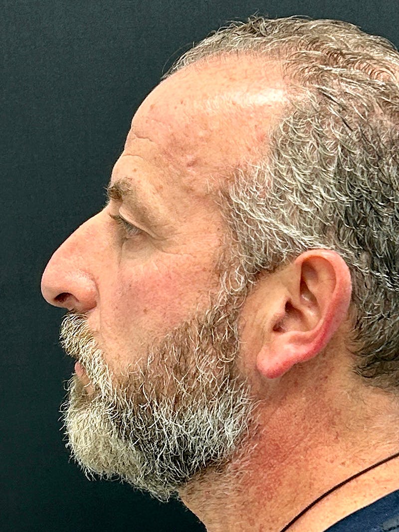 Blepharoplasty Before & After Gallery - Patient 669983 - Image 7