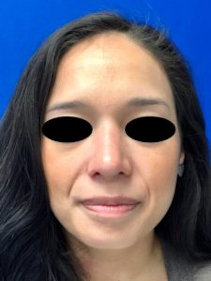 Primary Rhinoplasty Before & After Gallery - Patient 879608 - Image 4