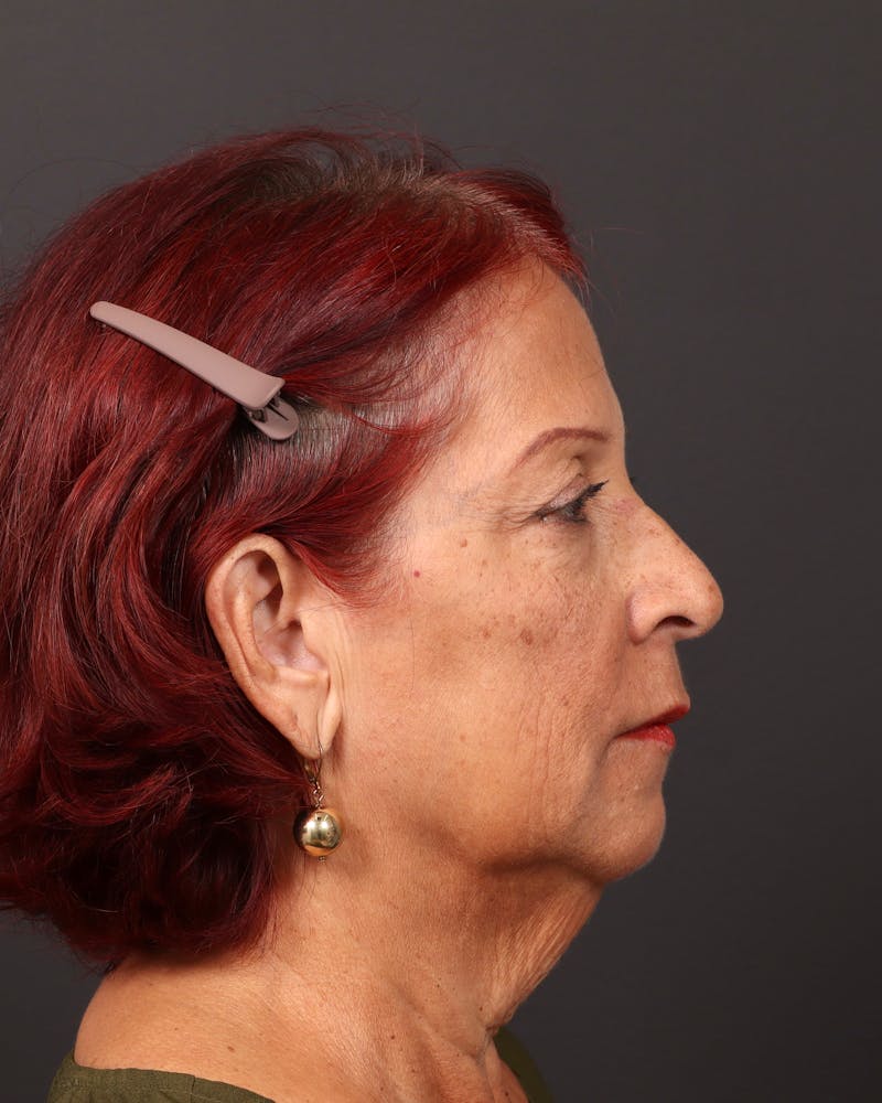 Facelift Before & After Gallery - Patient 171272 - Image 5