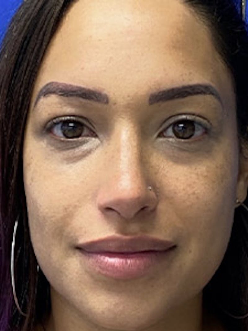 Primary Rhinoplasty Before & After Gallery - Patient 357224 - Image 4