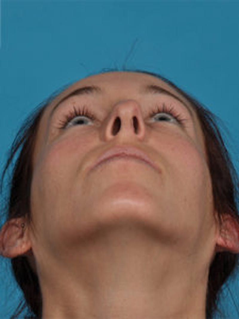 Primary Rhinoplasty Before & After Gallery - Patient 262137 - Image 5