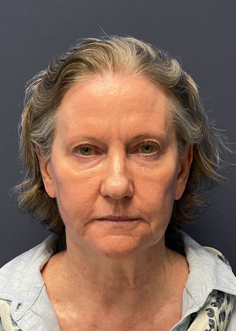 Blepharoplasty Before & After Gallery - Patient 108643 - Image 1