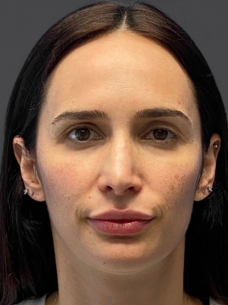 Revision Rhinoplasty Before & After Gallery - Patient 240059 - Image 3