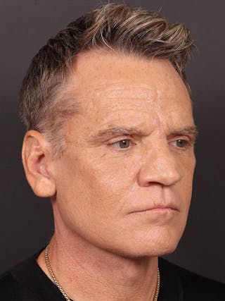 Blepharoplasty Before & After Gallery - Patient 322814 - Image 4
