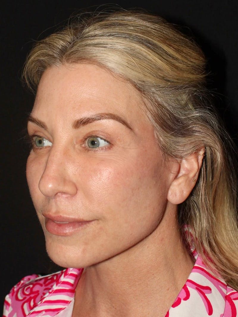 Facelift Before & After Gallery - Patient 420053 - Image 4
