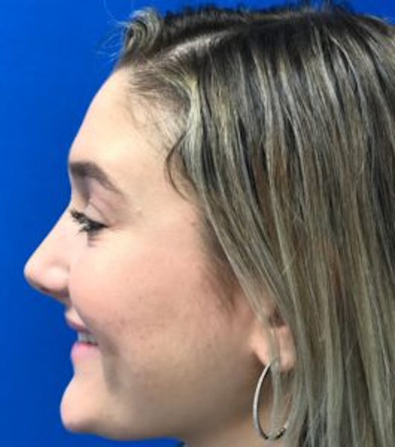 Primary Rhinoplasty Before & After Gallery - Patient 320169 - Image 12
