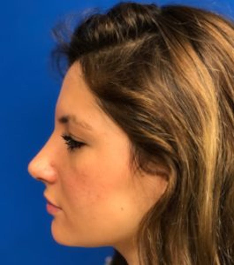 Primary Rhinoplasty Before & After Gallery - Patient 550195 - Image 12