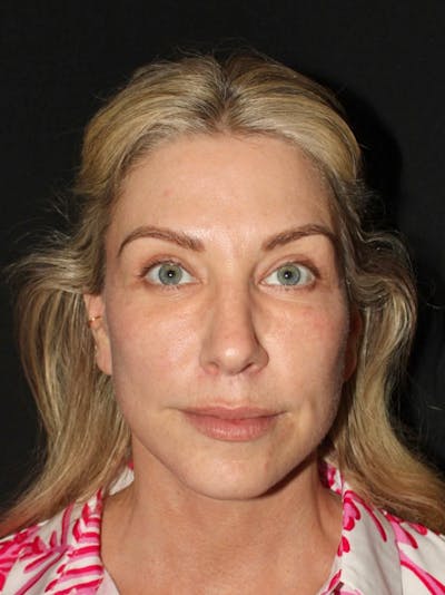 Facelift Before & After Gallery - Patient 420053 - Image 2
