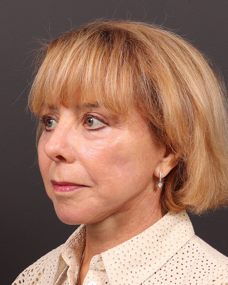 Facelift Before & After Gallery - Patient 304571 - Image 4