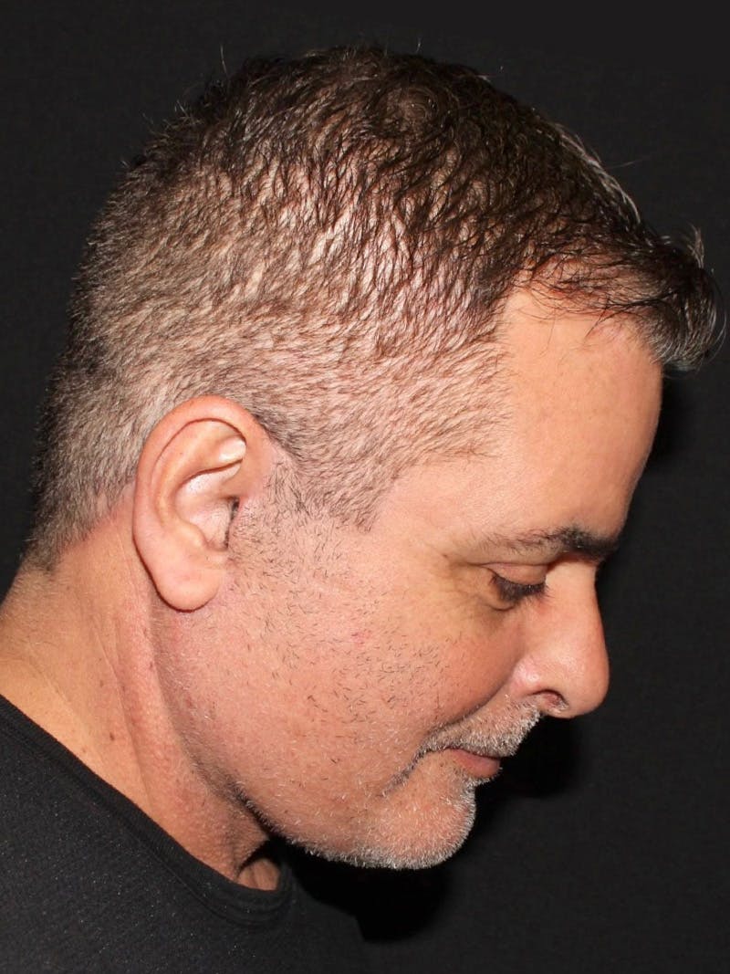Blepharoplasty Before & After Gallery - Patient 316919 - Image 8