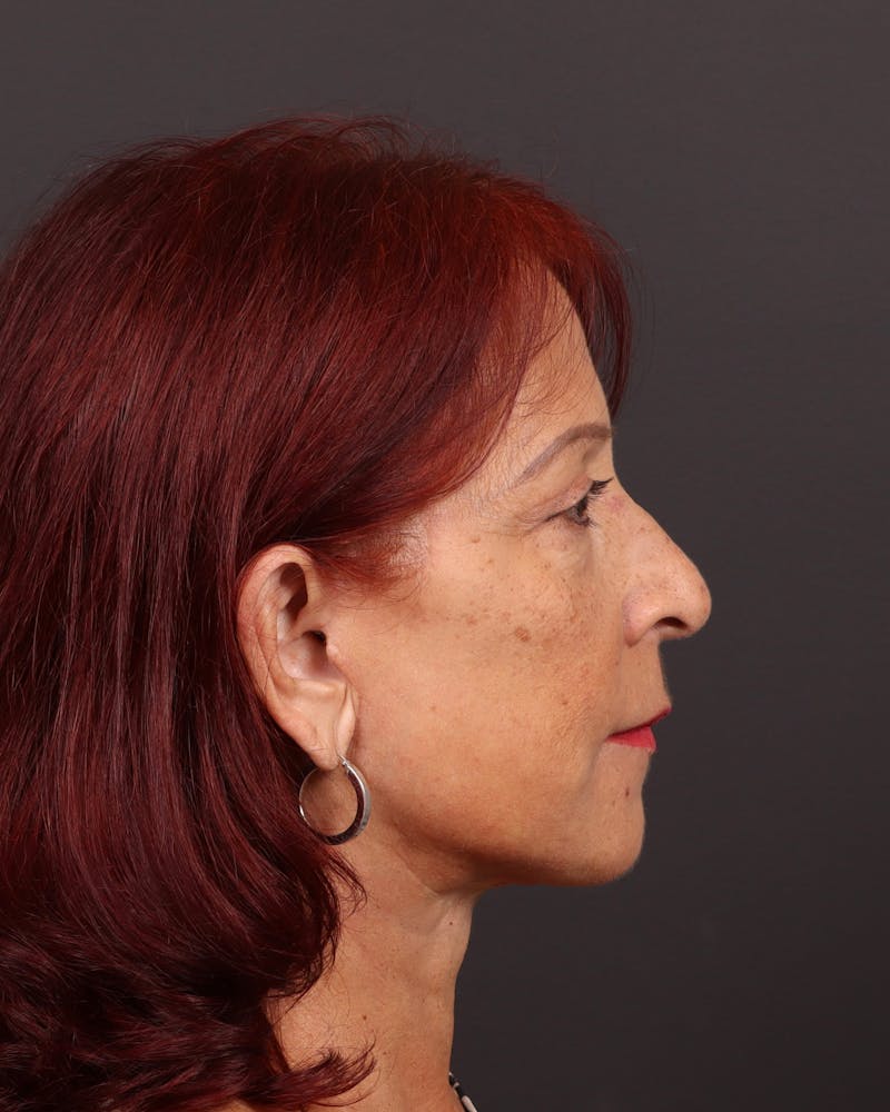 Facelift Before & After Gallery - Patient 171272 - Image 6