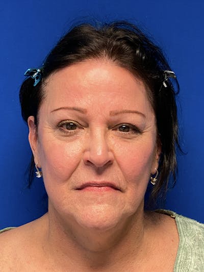 Facelift Before & After Gallery - Patient 181164 - Image 1