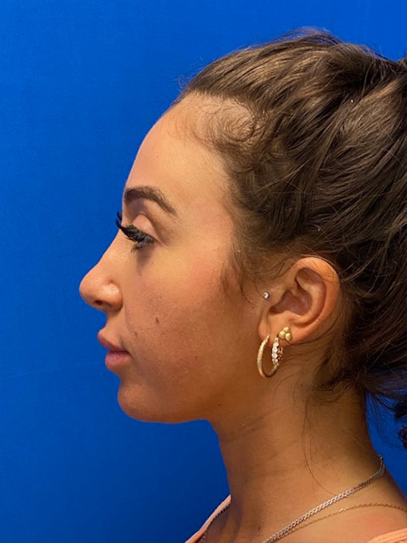 Primary Rhinoplasty Before & After Gallery - Patient 334537 - Image 5
