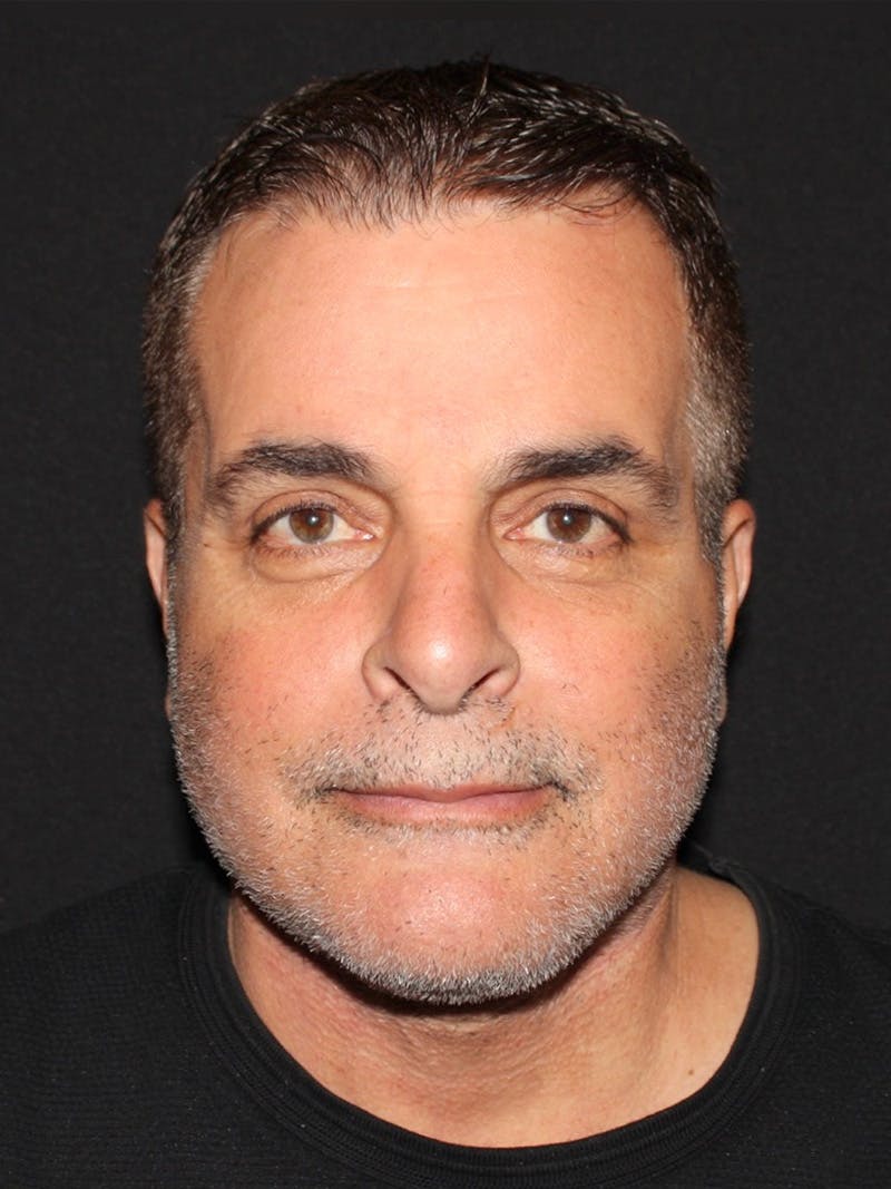 Blepharoplasty Before & After Gallery - Patient 316919 - Image 2