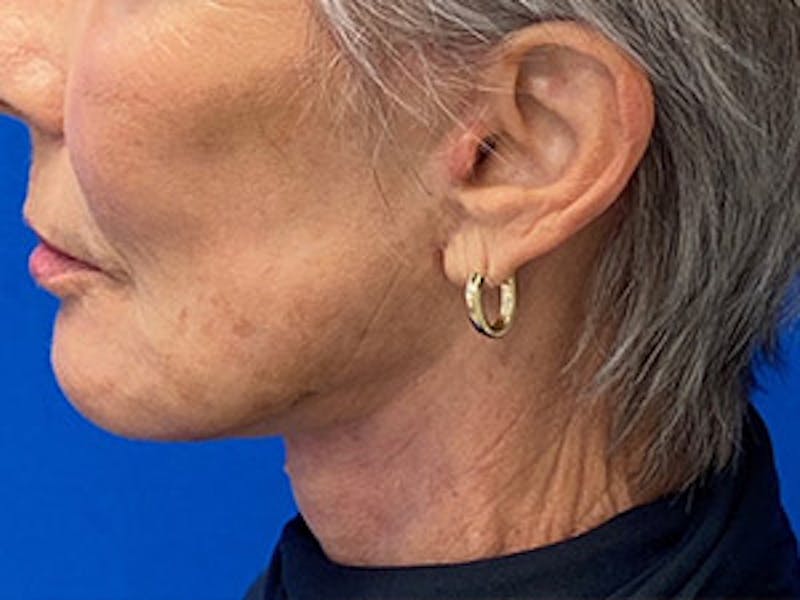 Neck Lift Before & After Gallery - Patient 261431 - Image 4