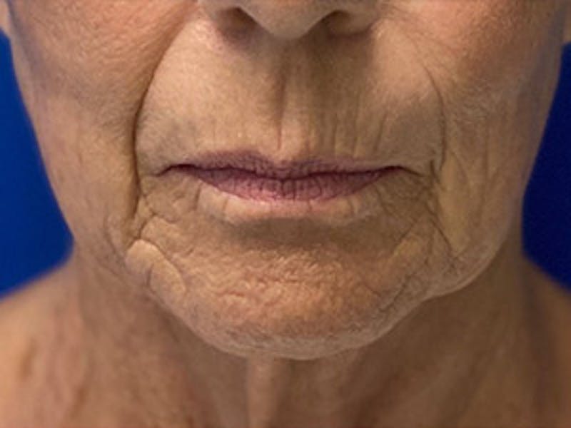 Neck Lift Before & After Gallery - Patient 261431 - Image 1