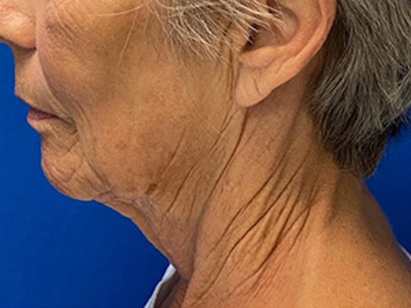 Neck Lift Before & After Gallery - Patient 261431 - Image 3