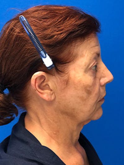 Neck Lift Before & After Gallery - Patient 341393 - Image 1