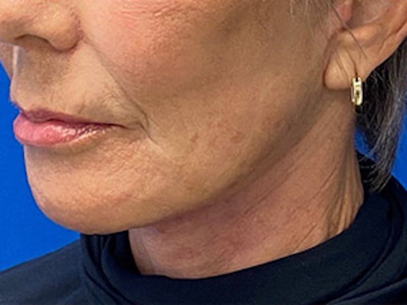 Neck Lift Before & After Gallery - Patient 261431 - Image 6