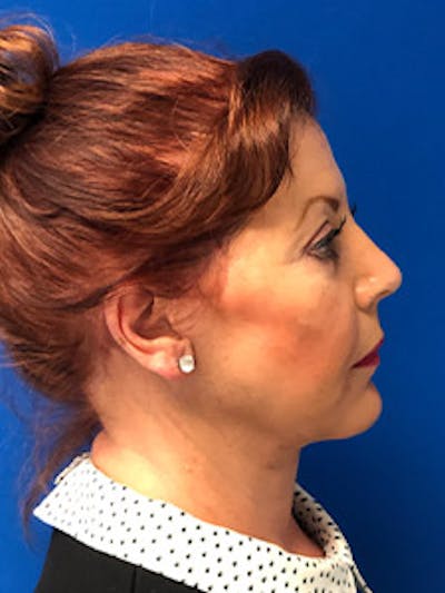 Neck Lift Before & After Gallery - Patient 341393 - Image 2