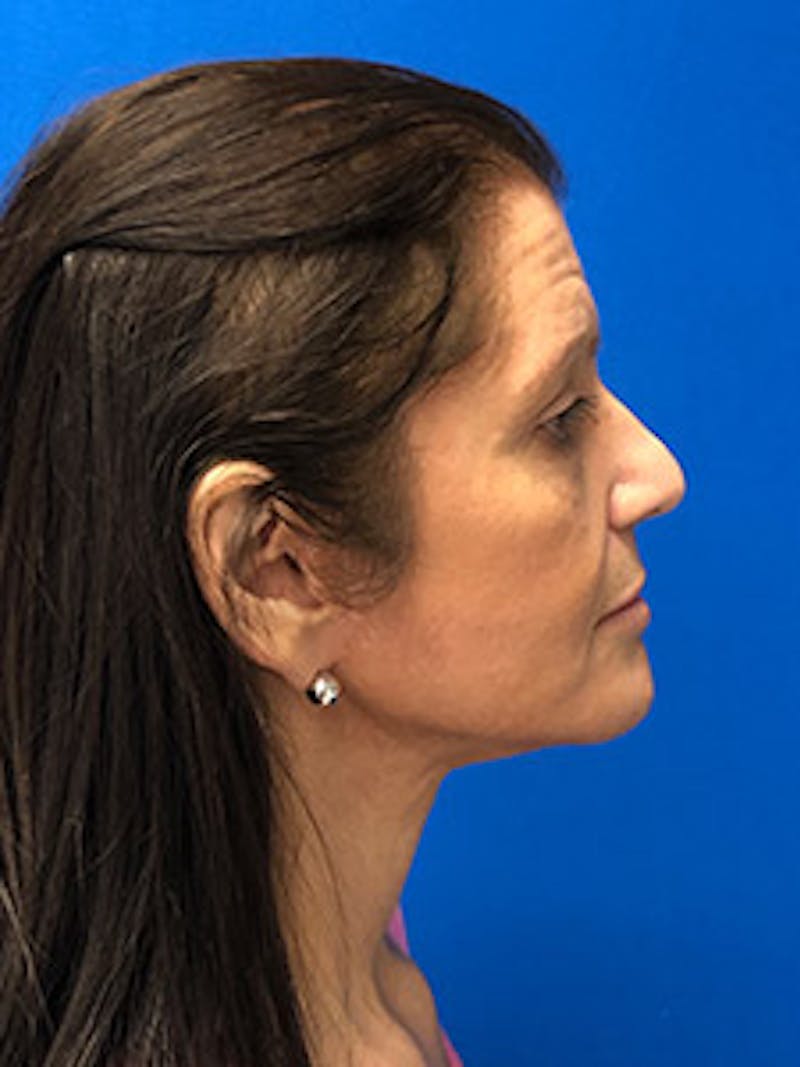 Neck Lift Before & After Gallery - Patient 298830 - Image 2