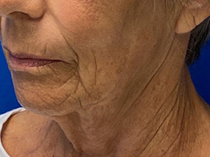 Neck Lift Before & After Gallery - Patient 261431 - Image 5