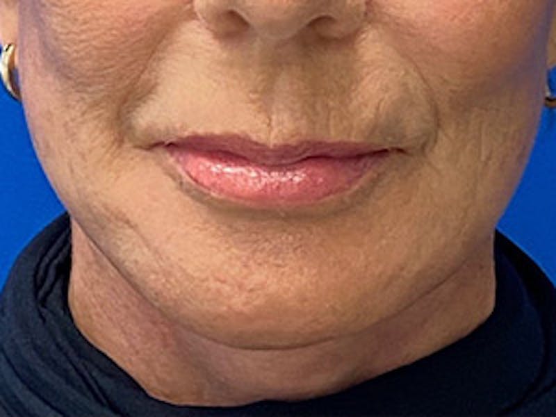 Neck Lift Before & After Gallery - Patient 261431 - Image 2