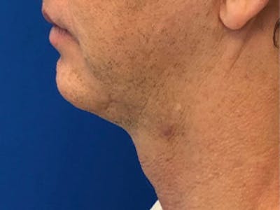 Neck Lift Before & After Gallery - Patient 350781 - Image 1