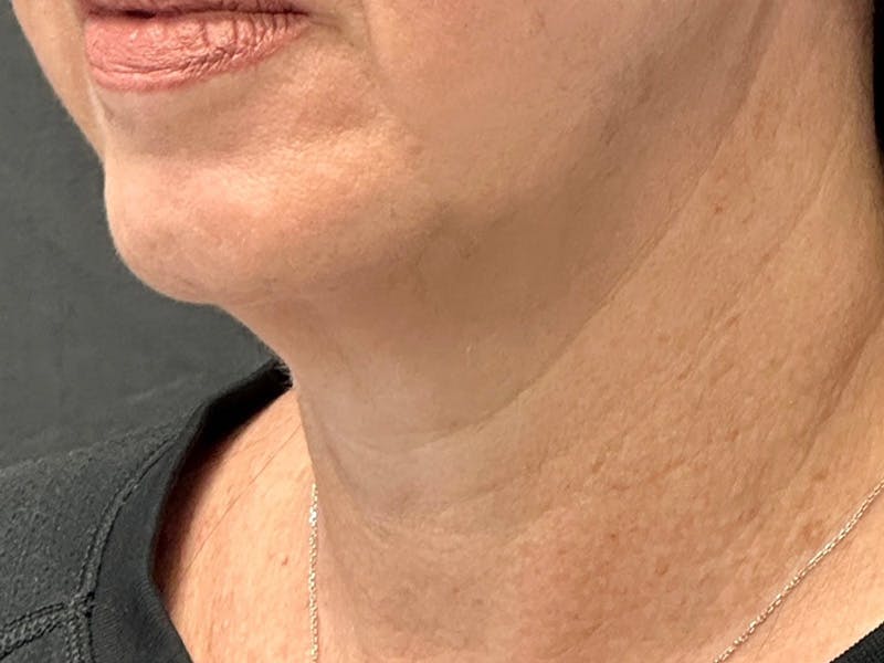 Neck Lift Before & After Gallery - Patient 251242 - Image 3