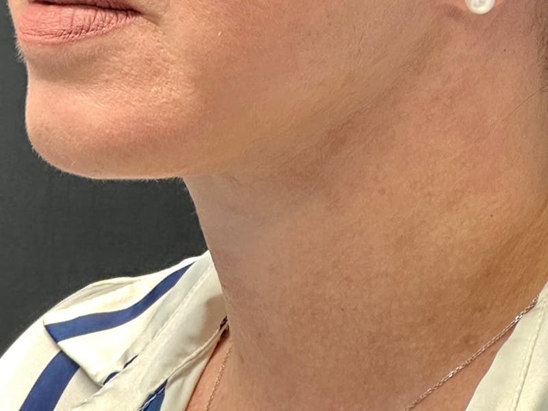 Neck Lift Before & After Gallery - Patient 251242 - Image 4