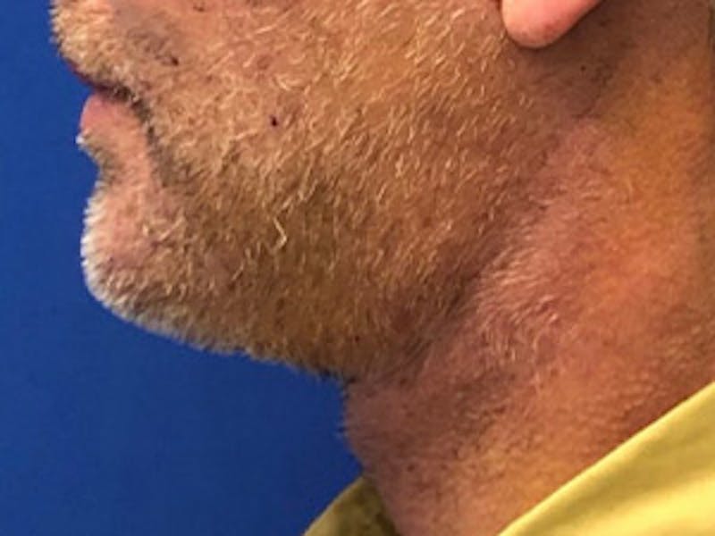 Neck Lift Before & After Gallery - Patient 350781 - Image 2