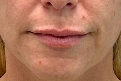 Lip Lift Before & After Gallery - Patient 345471 - Image 1