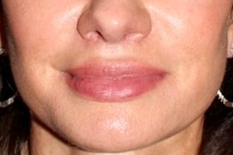Lip Lift Before & After Gallery - Patient 247443 - Image 2