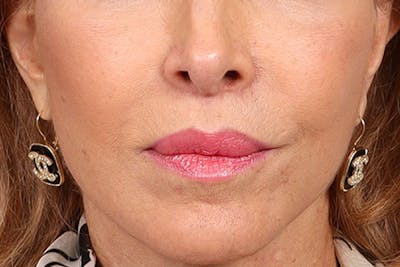Lip Lift Before & After Gallery - Patient 198845 - Image 2