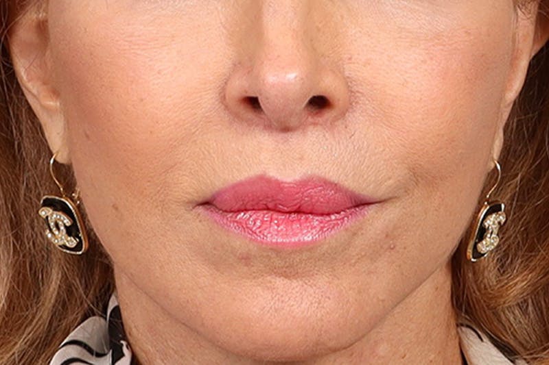 Lip Lift Before & After Gallery - Patient 198845 - Image 2