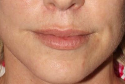 Lip Lift Before & After Gallery - Patient 345471 - Image 2