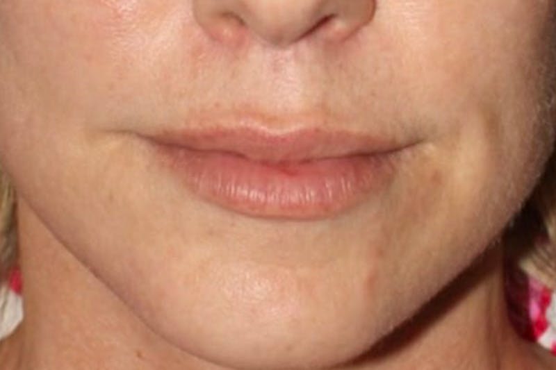 Lip Lift Before & After Gallery - Patient 345471 - Image 2