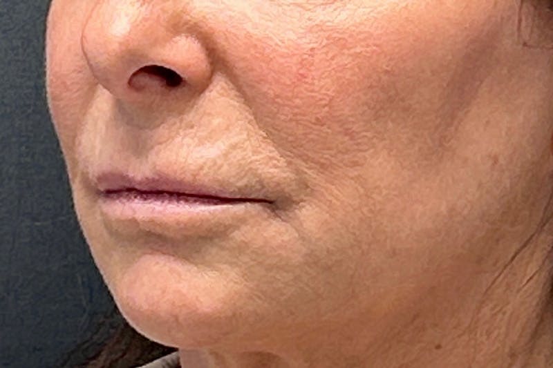 Lip Lift Before & After Gallery - Patient 190265 - Image 3