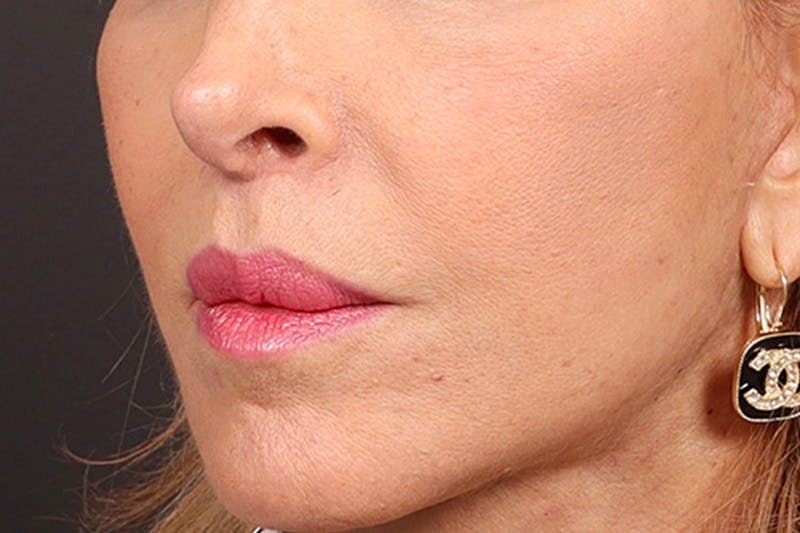 Lip Lift Before & After Gallery - Patient 198845 - Image 4