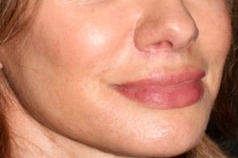 Lip Lift Before & After Gallery - Patient 247443 - Image 4