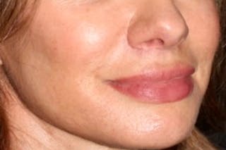Lip Lift Before & After Gallery - Patient 247443 - Image 4