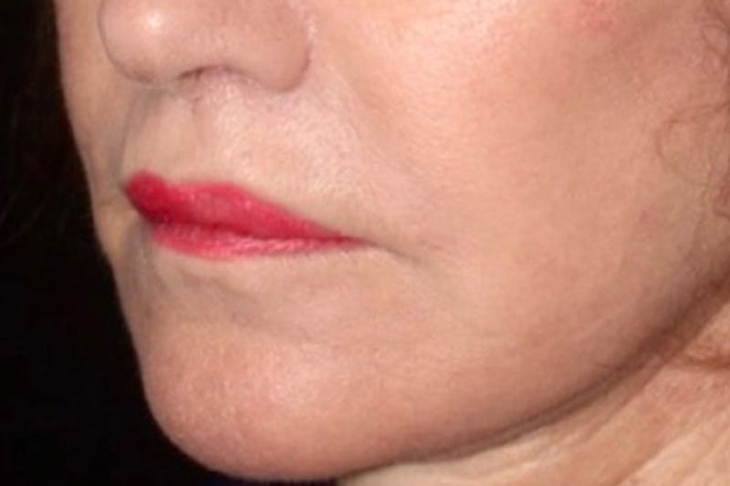 Lip Lift Before & After Gallery - Patient 221162 - Image 4