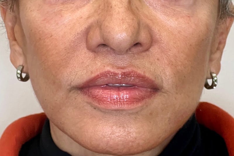 Lip Lift Before & After Gallery - Patient 371532 - Image 2