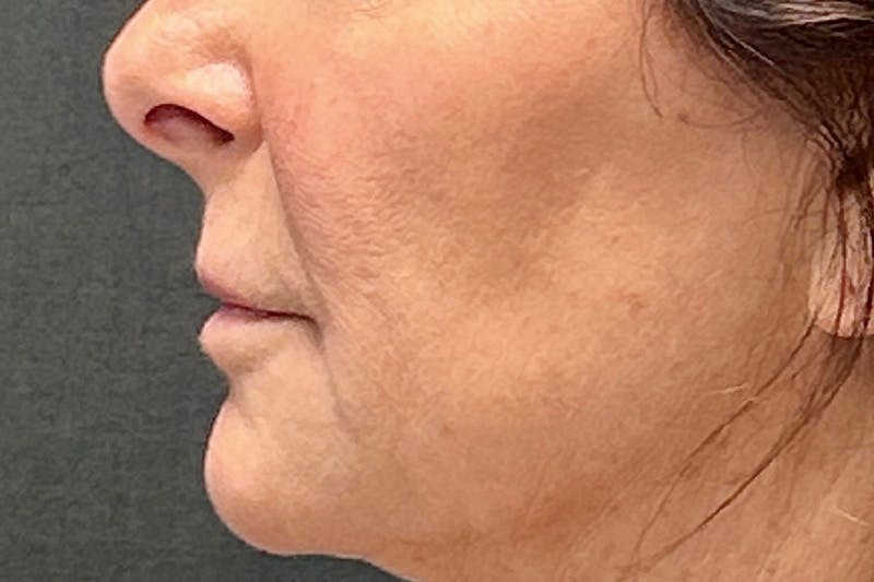 Lip Lift Before & After Gallery - Patient 190265 - Image 5