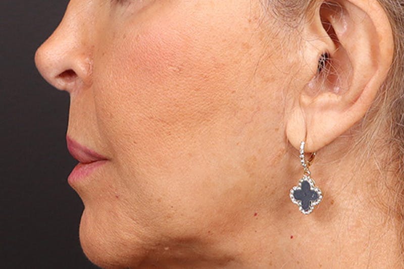 Lip Lift Before & After Gallery - Patient 198845 - Image 5