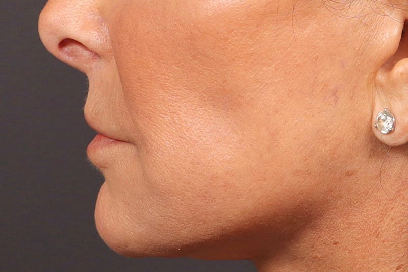 Lip Lift Before & After Gallery - Patient 190265 - Image 6