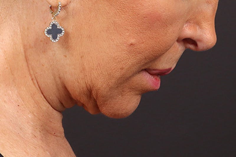 Lip Lift Before & After Gallery - Patient 198845 - Image 7